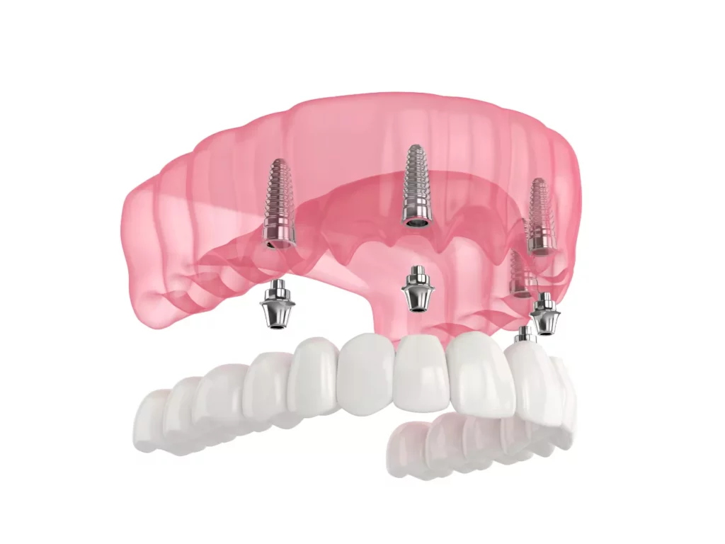 Illustration of a full arch model.