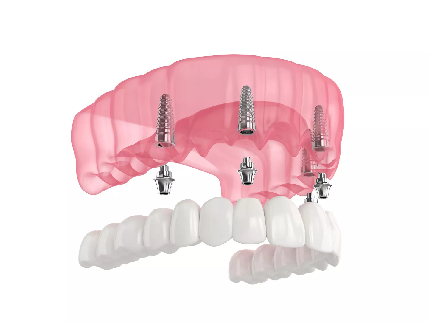 An illustration of a full arch model.