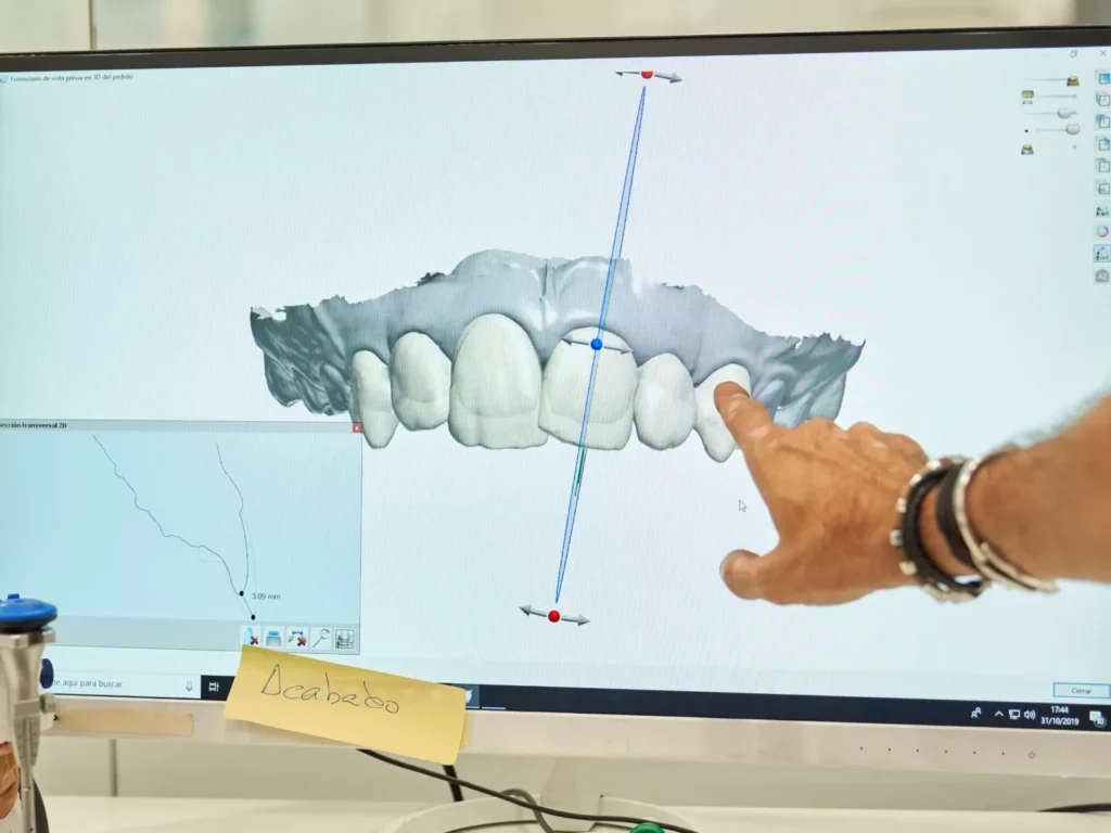 Image of a scan of upper teeth.
