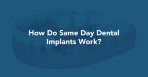 How Do Same Day Dental Implants Work? at Prestige Oral Surgery