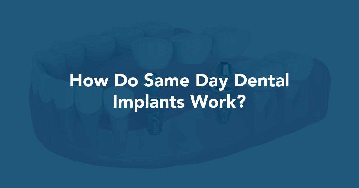 How Do Same Day Dental Implants Work? at Prestige Oral Surgery